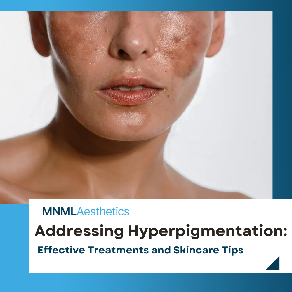 Addressing Hyperpigmentation: Effective Treatments and Skincare Tips