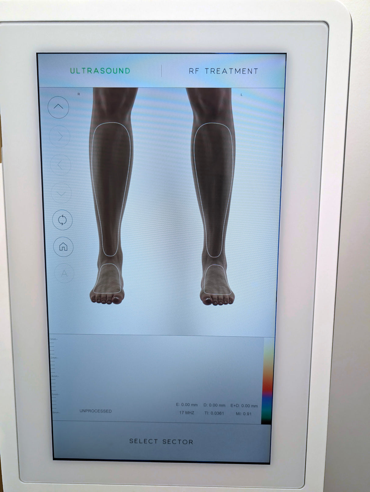 2023 Vivace Ultra Ultrasound-Guided RF Microneedling Platform Training Included